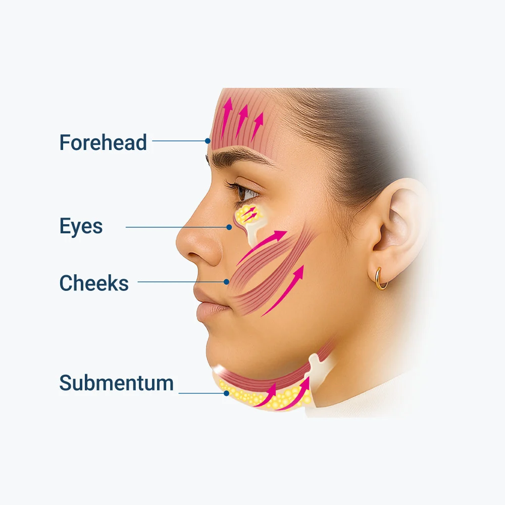 EMFACE® Needle-Free Facial Rejuvenation