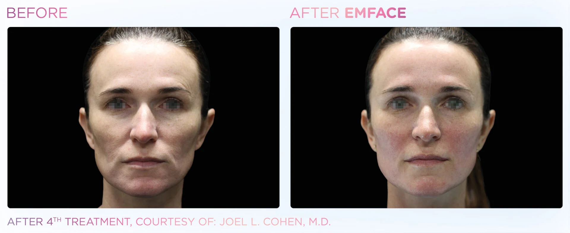 After Treatment