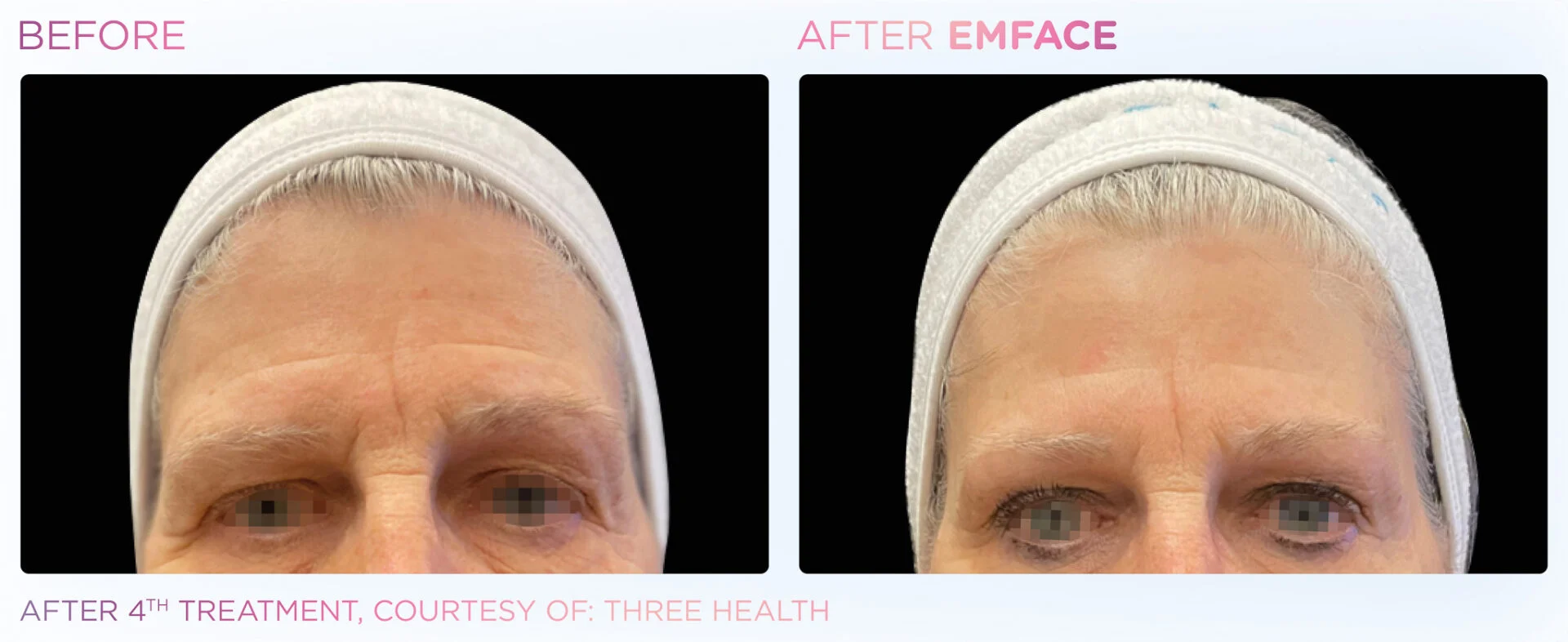 Before Treatment