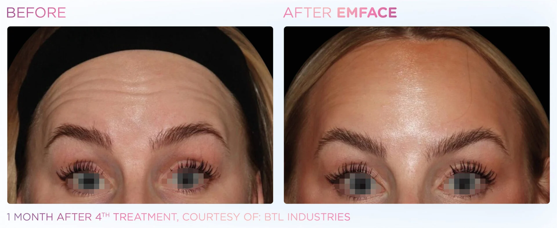 Before Treatment