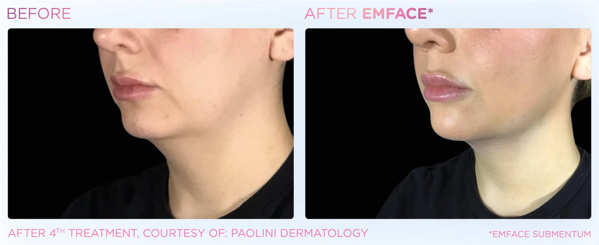 Before Treatment